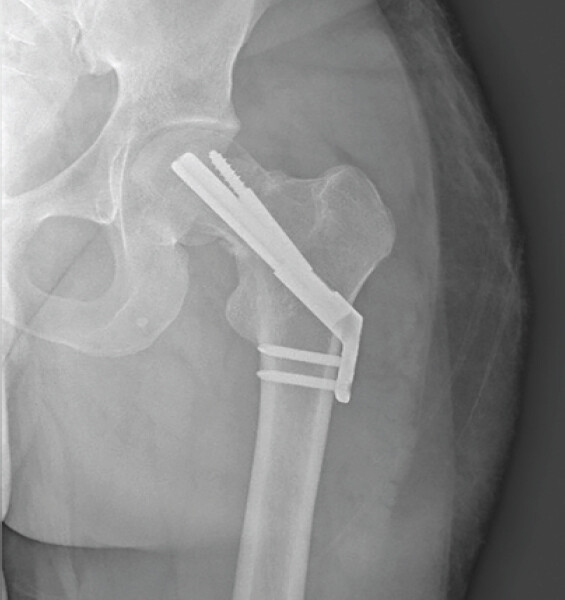 Figure 3: Radiographs show varus displacement of the left femoral neck fracture following initial surgical intervention.