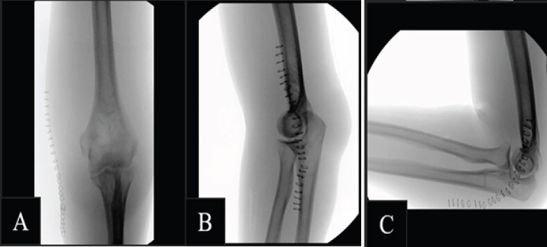 Figure 3: Intraoperative fluoroscopic evaluation and post-operative radiographs. (a) Posterior fluoroscopic view demonstrating a concentrically reduced ulnohumeral joint following irrigation and debridement. (b) Lateral fluoroscopic view with the forearm extended, confirming maintained reduction and stable alignment. (c) Lateral fluoroscopic view with the elbow flexed to 90°, showing persistent joint congruence without subluxation.