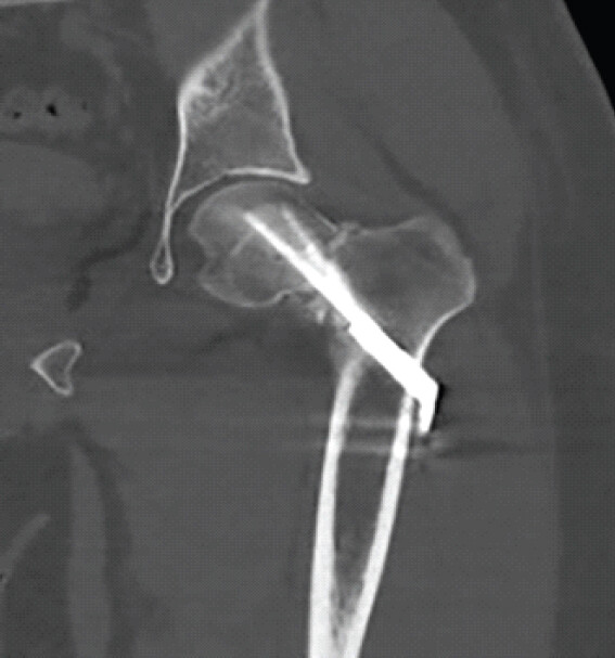 Figure 4: Computed tomography radiographs of the left femoral neck fracture with implants confirm varus malalignment.