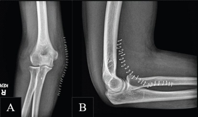 Figure 4: One-month post-operative radiographs (a and b). (a) Post-operative anterior-posterior radiograph demonstrating anatomic alignment of the ulnohumeral and radiocapitellar joints following soft-tissue repair. (b) Post-operative lateral radiograph confirming stable reduction and appropriate post-operative positioning.