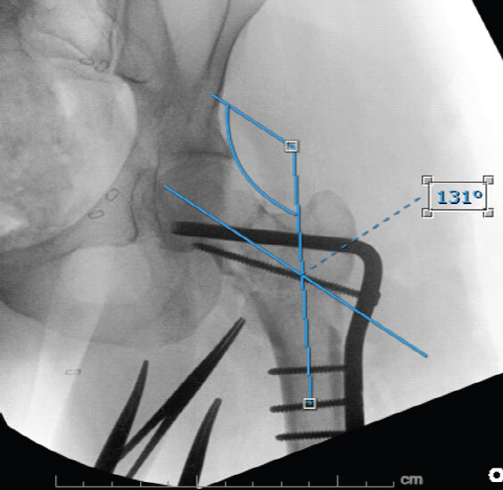 Figure 5: Intraoperative surgical revision correcting varus malalignment with a blade plate and 4.5 mm cortical screw.