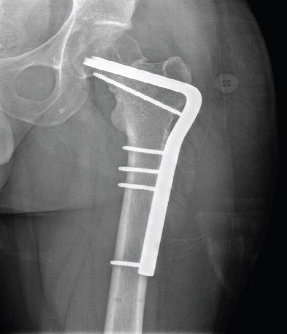 Figure 6: Post-operative radiograph of the pelvis at 2-month follow-up visit with restoration of alignment.