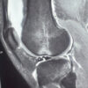 Meniscal Duplication Sign (“Trowel sign”): A Novel Magnetic Resonance Imaging Indicator of Lateral Meniscus Bucket-Handle Tear