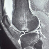 Figure 1: Trowel sign on magnetic resonance imaging - *Attached anterior horn as the blade of trowel, #Displaced anterior fragment as the handle of trowel.