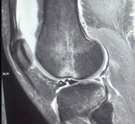 Figure 1: Trowel sign on magnetic resonance imaging - *Attached anterior horn as the blade of trowel, #Displaced anterior fragment as the handle of trowel.