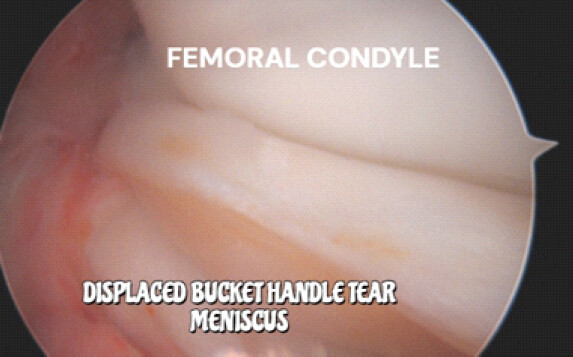 Figure 3: Bucket-handle fragment lying within the lateral compartment as seen during arthroscopy.