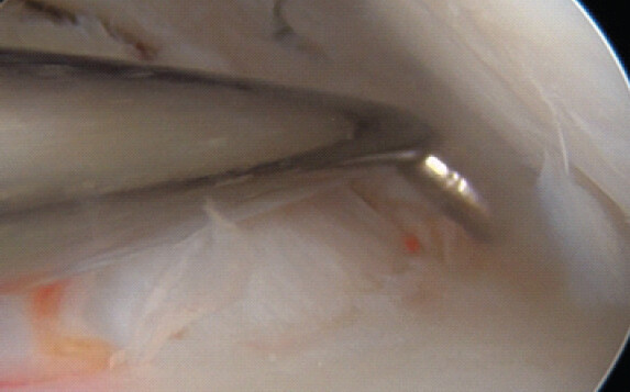 Figure 4: Bucket-handle fragment being reduced temporarily with probe.
