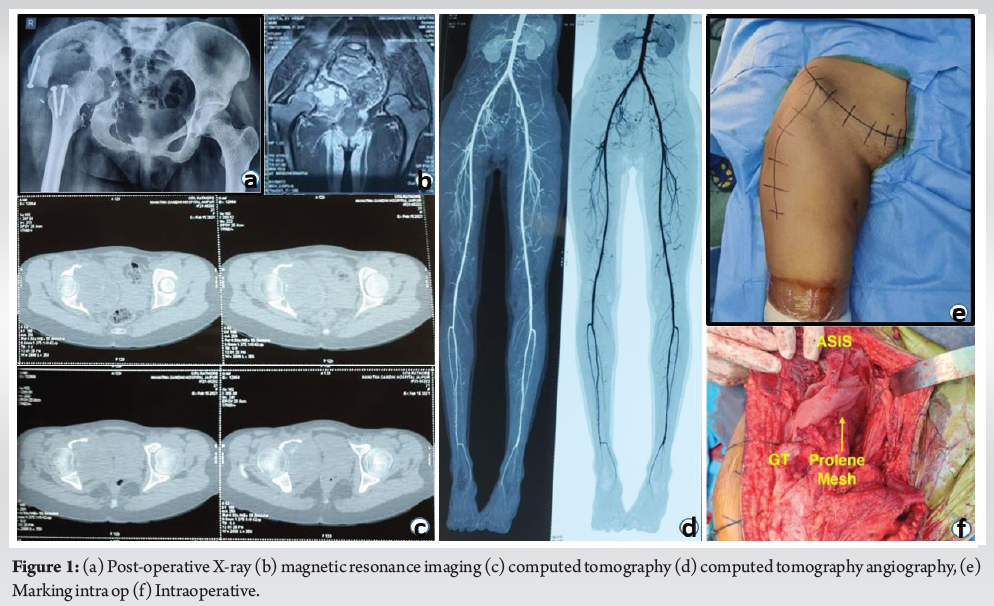 Low-Grade Myofibroblastic Sarcoma of the Acetabulum – A Rare Case with ...