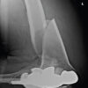 Management of Periprosthetic Total Knee Infection with Partial Hardware Removal: A Case Report