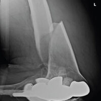 Figure 1: Lateral X-ray of left femur fracture. A spiral fracture involving the middle and distal thirds of the femur. Knee prosthesis remains intact.