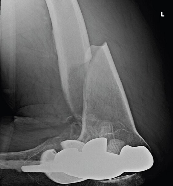 Figure 1: Lateral X-ray of left femur fracture. A spiral fracture involving the middle and distal thirds of the femur. Knee prosthesis remains intact.