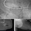 Primary Total Hip Arthroplasty for a Displaced Femoral Neck Fracture in an Above-the-Knee Amputee: A Case Report