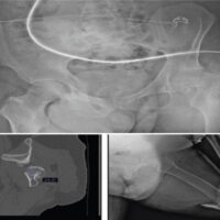 Figure 1: Pre-operative radiograph and axial computed tomography demonstrating displaced transcervical femoral neck fracture with posterior tilt (~24°) in a left above-the-knee amputee.