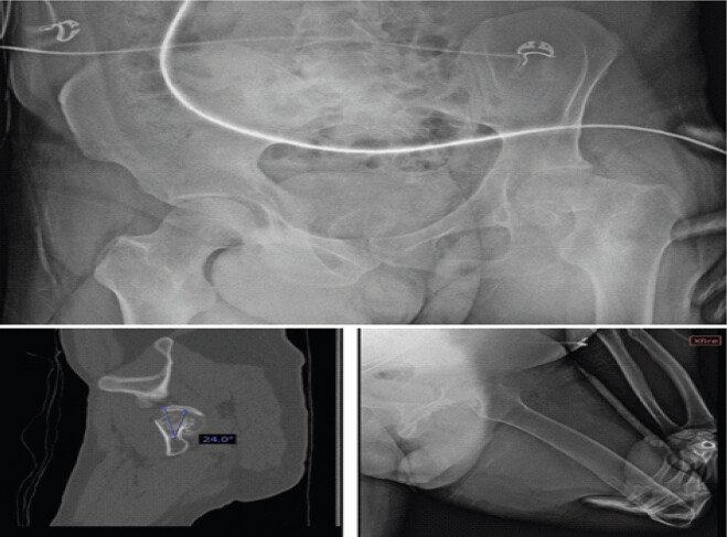 Figure 1: Pre-operative radiograph and axial computed tomography demonstrating displaced transcervical femoral neck fracture with posterior tilt (~24°) in a left above-the-knee amputee.