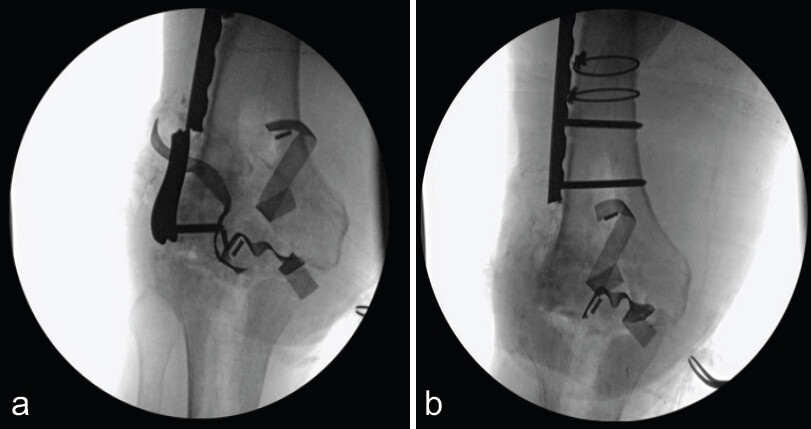 Figure 2: Intra-operative fluoroscopy of removed distal femoral plate. (a) Intra-articular plate separated from proximal plate. (b) Removed distal, intra-articular plate and screw.