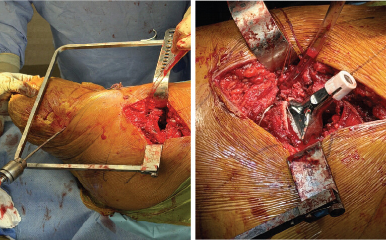 Figure 2: A fully threaded Steinmann pin inserted into the distal anterolateral femoral stump provides a temporary lever arm to control rotation and flexion of the residual limb during acetabular and femoral preparation. High-offset femoral stem implanted with 10–15° anteversion, demonstrating restoration of leg length and soft-tissue balancing. Calcar fragment secured with cerclage cable.