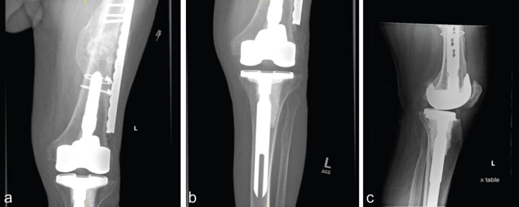 Figure 3: Left femur X-rays 2 months after stage 2 revision. (a) Anteroposterior (AP) of proximal femur with partial lateral plate retained demonstrating callus formation. AP (b) and lateral (c) views of knee showing properly aligned cemented total knee arthroplasty revision.