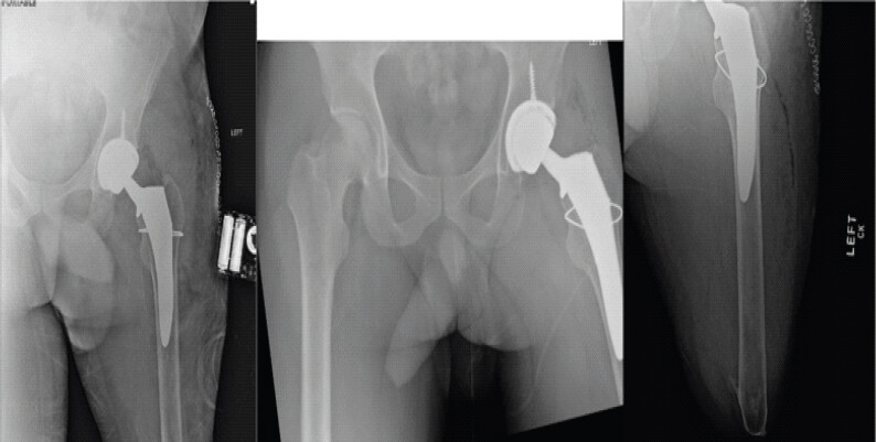 Figure 3: Anteroposterior left hip and pelvis radiographs demonstrating appropriate alignment and stable fixation of acetabular and femoral components. Calcar fragment secured with cerclage cable.