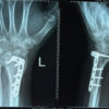 Delayed Rupture of the Extensor Pollicis Longus Tendon following Dorsal Plating of a Distal Radius Fracture in a Rheumatoid Arthritis Patient with Differing Ultrasonographic Findings: A Case Report