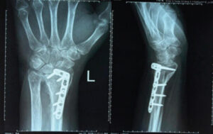 Figure 1: Pre-operative radiograph showing a united distal radius fracture with dorsal plate and screw fixation with distal plate prominence.