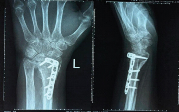Figure 1: Pre-operative radiograph showing a united distal radius fracture with dorsal plate and screw fixation with distal plate prominence.