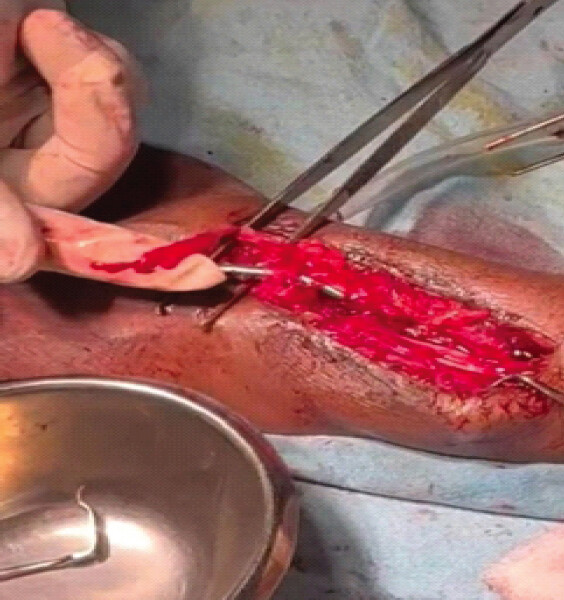 Figure 3: Distal end of ruptured extensor pollicis longus tendon.