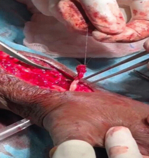 Figure 4: Tagged distal end of extensor pollicis longus tendon.