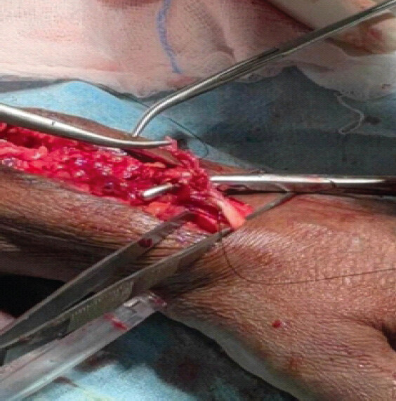 Figure 5: Extensor indicis proprius to extensor pollicis longus tendon repair.