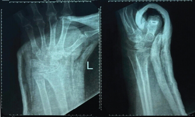 Figure 6: Post-operative radiograph showing implant removal with limb immobilized in a thumb spica splint.