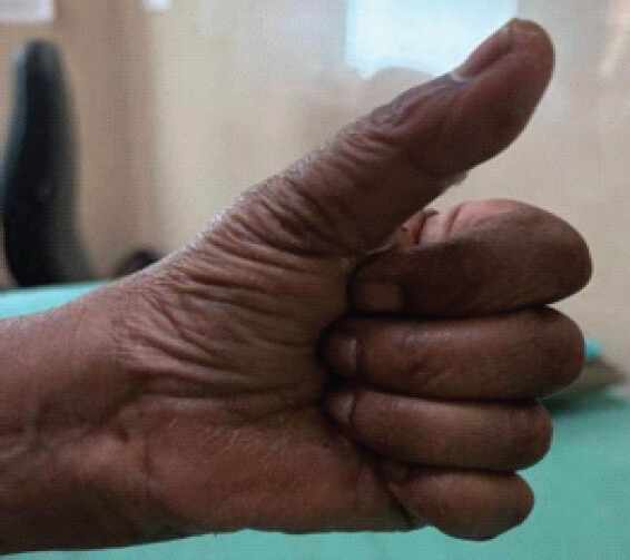 Figure 7: Thumb extension at 8 weeks.