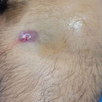 Figure 1: Gunshot entry wound on the left upper thigh near the groin at initial presentation.