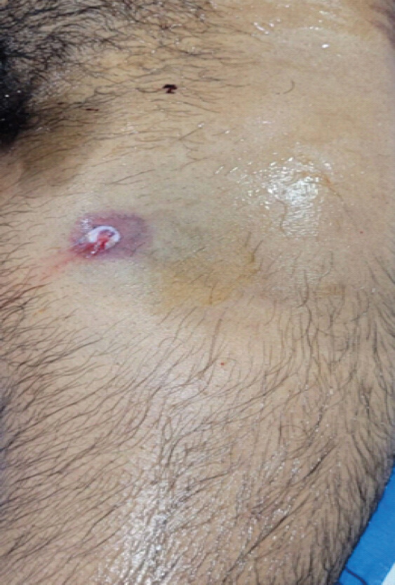 Figure 1: Gunshot entry wound on the left upper thigh near the groin at initial presentation.