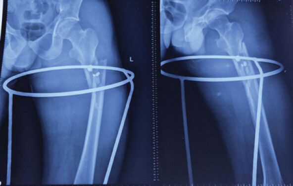 Figure 2: Anteroposterior and lateral radiographs of the left hip and thigh showing a comminuted subtrochanteric femoral fracture with an adjacent retained bullet fragment stabilized in a Thomas splint.