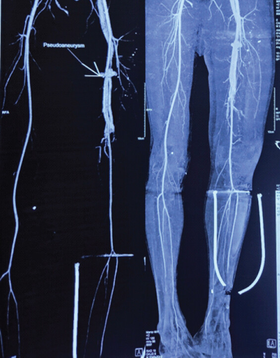 Figure 3: Computed tomography angiography of the lower limbs showing an arteriovenous fistula with contrast leak at the left proximal superficial femoral vessels; note the preserved flow distal to the fistula.
