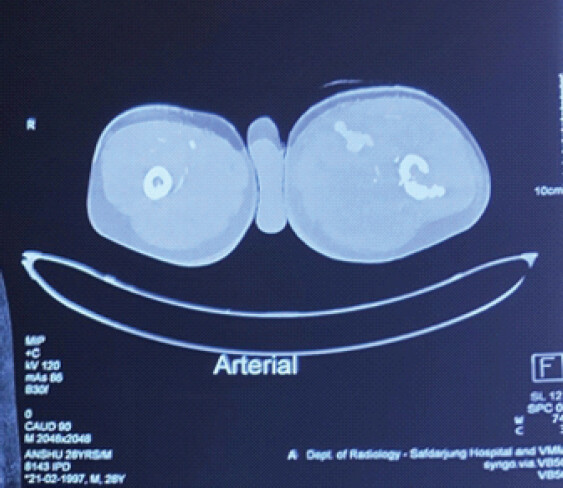Figure 4: Axial computed tomography angiographic image at the level of the fistula.