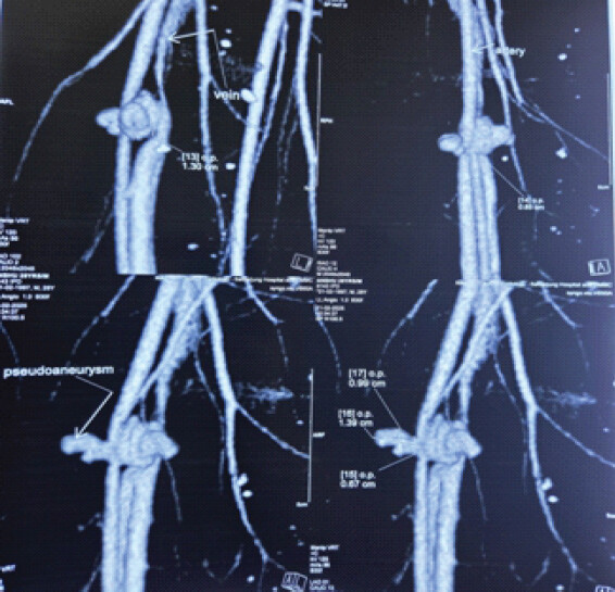Figure 5: Three-dimensional reconstruction of the computed tomography angiogram demonstrating the pseudoaneurysm.
