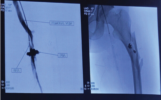 Figure 6: Fluoroscopy-guided deployment of the covered stent graft in the superficial femoral artery (left to right: passage of the guidewire; passage of the stent).
