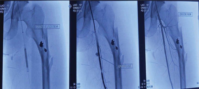 Figure 7: Left to right: Balloon dilation of the endovascular stent; patency check after dilation; adequate distal flow after stent placement.
