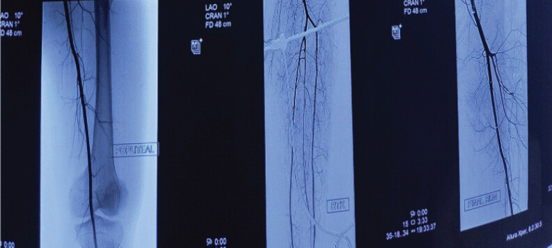 Figure 8: Left to right: Restored flow in the popliteal artery and its distal branches after stenting; final contrast run showing normal flow with no leak.