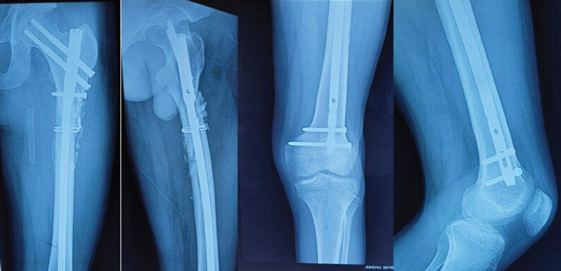 Figure 9: Follow-up anteroposterior and lateral radiographs of the proximal and distal femur at 6 months after injury (approximately 4 months after fixation), showing union.
