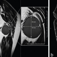 Figure 1: Preoperative magnetic resonance imaging of the left gluteal region. (a) Coronal T1-weighted image demonstrates a well-circumscribed ovoid intramuscular mass in the distal gluteus maximus adjacent to the ischium, with low signal intensity relative to surrounding fat. (b) Sagittal T2-weighted fat-suppressed image confirms the craniocaudal extent of the lesion and its relationship to the gluteal and posterior proximal thigh musculature. No osseous destruction is evident in the images shown.
