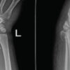 Concomitant Distal Radius Fracture with Scaphoid Fracture-Dislocation and Carpal Instability: A Case Report