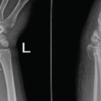 Figure 1: Preoperative anteroposterior (a) and lateral (b) radiographs of the left wrist demonstrating a comminuted intra-articular distal radius fracture involving the lunate facet with volar displacement, associated with a scaphoid waist fracture and volar dislocation of the scaphoid–carpal complex.