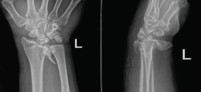 Figure 1: Preoperative anteroposterior (a) and lateral (b) radiographs of the left wrist demonstrating a comminuted intra-articular distal radius fracture involving the lunate facet with volar displacement, associated with a scaphoid waist fracture and volar dislocation of the scaphoid–carpal complex.