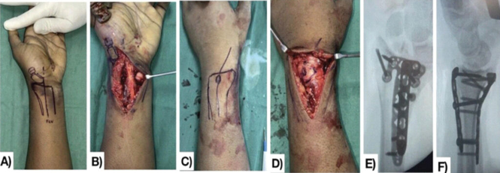 Figure 2: Surgical sequence (distal radius fixation). (a) Preoperative soft-tissue contusion and swelling. (b) Volar exposure through the modified Henry approach showing the displaced scaphoid fragment. (c) Marking of the planned dorsal approach. (d) Dorsal exposure of the distal radioulnar joint and carpal region. (e and f) Intraoperative anteroposterior and lateral fluoroscopic views showing volar and dorsal plate fixation of the distal radius.