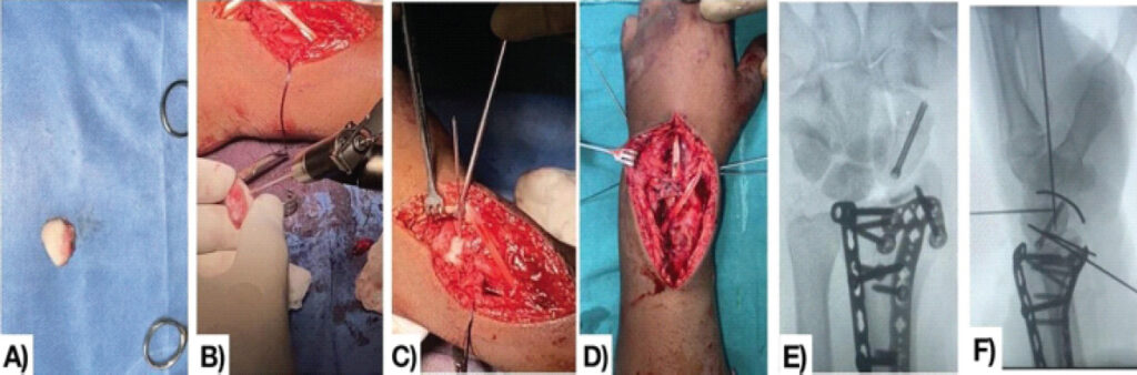 Figure 3: Intraoperative sequence demonstrating scaphoid and carpal stabilization. (a) Retrieved scaphoid fragment after preparation. (b) Kirschner-wire (K-wire) fixation of the scaphoid fragment. (c) Reduction and restoration of the scaphoid articulation for fixation. (d) Dorsal exposure showing the intercarpal region, with the extensor pollicis longus (*) and extensor carpi radialis brevis (#) identified and protected, repaired intercarpal ligaments (++), and Kirschner wires stabilizing the carpal rows. (e) Scaphoid fixation with a Herbert screw. (f) Final lateral fluoroscopic view demonstrating K-wire stabilization of the carpal rows with maintained carpal alignment.