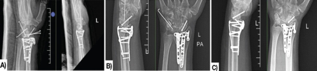 Figure 4: Serial radiographic follow-up of the left wrist. (a) Immediate post-operative anteroposterior and lateral radiographs showing maintained reduction and fixation with volar and dorsal plates, Herbert screw, and carpal Kirschner-wire (K-wires). (b) Six-week follow-up radiographs demonstrating maintained alignment following K-wire removal. (c) Eight-month follow-up radiographs showing radiological union of the distal radius and scaphoid with maintained carpal alignment.