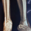 Salvage of Complex Bimalleolar Ankle Fracture Non-union after Failed Tibiotalocalcaneal and Charnley Arthrodesis using Fibular Strut Grafting and Ilizarov Fixation: A Case Report