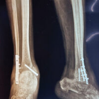Figure 1: Immediate post-operative anteroposterior and lateral radiographs of the right ankle following open reduction and internal fixation for a bimalleolar fracture, showing plate fixation of the lateral malleolus and screw fixation of the medial malleolus.