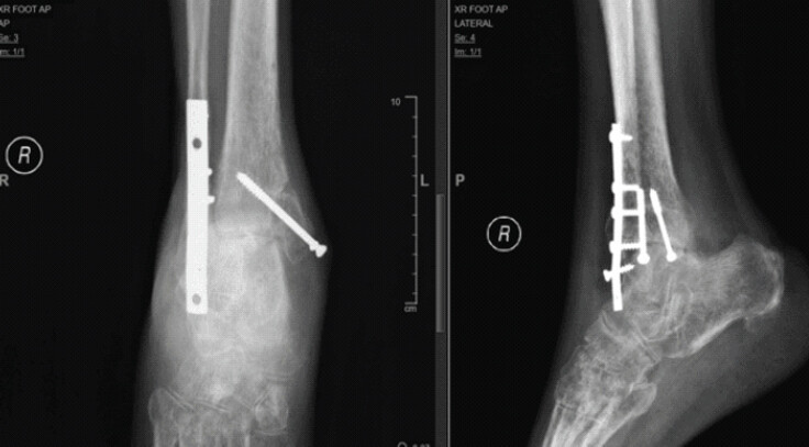 Figure 2: Follow-up anteroposterior and lateral radiographs of the right ankle demonstrating persistent non-union of the bimalleolar fracture with retained internal fixation hardware and features of ankle instability.
